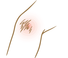 すり傷