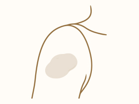 茶あざ（扁平母斑）