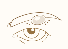 ​ひようのうし皮様嚢腫