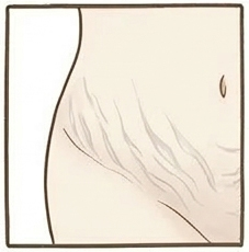 妊娠線