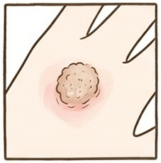 いぼ