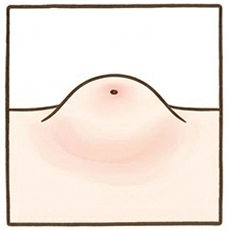 粉瘤（ふんりゅう）
