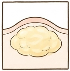 脂肪腫